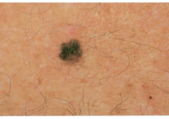 A series of images showing a skin lesion evolving in shape and elevation over a short period.