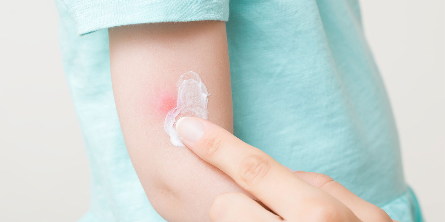 A person applying white antihistamine cream to a red mosquito bite on their skin for itch relief.