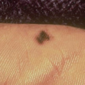 A dark, linear pigmentation streak appearing under a fingernail.