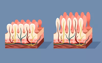 A medical diagram showing the difference between healthy intestinal villi and atrophied villi found in Celiac disease.