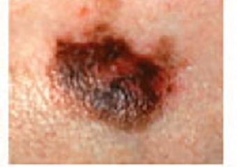A mole showing multiple shades of brown, black, and tan within a single lesion.