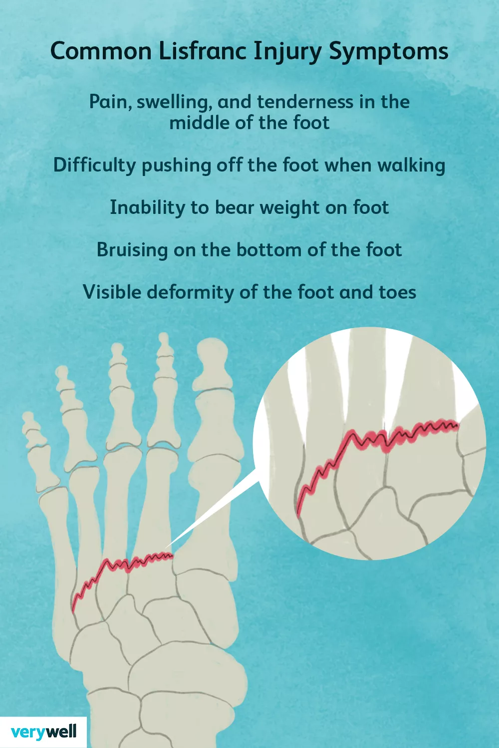 An anatomical illustration detailing the primary symptoms and pain points of a Lisfranc midfoot injury.