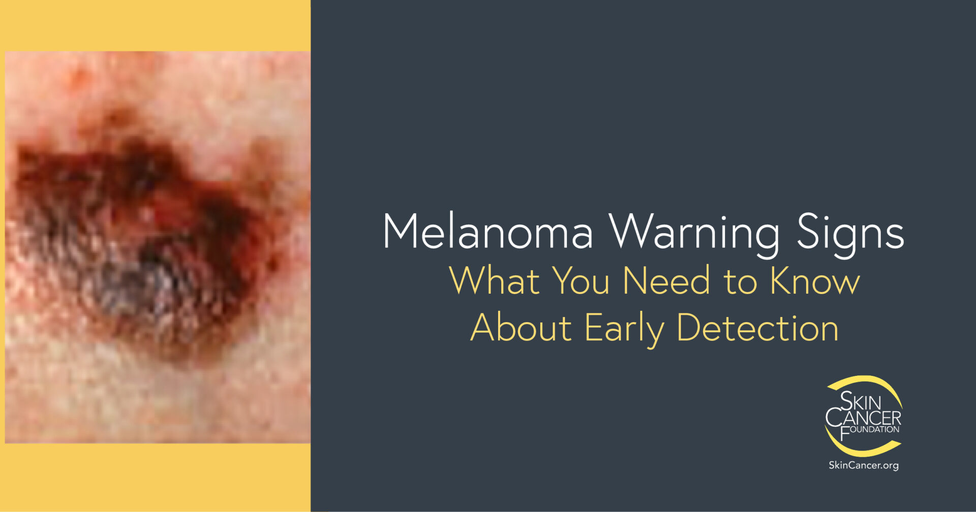 How to Detect Early Skin Cancer Signs & Warning Signs