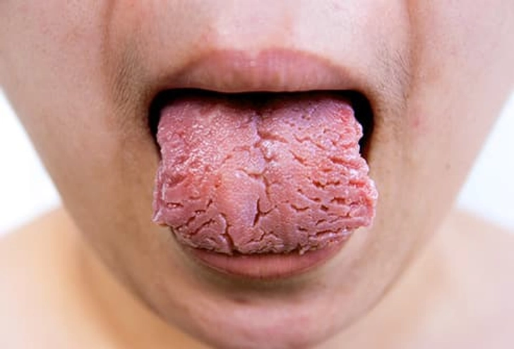 A tongue showing deep vertical and horizontal cracks on the surface