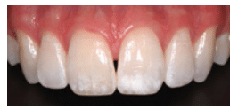 Close-up of central incisors showing localized white spot lesions caused by dental fluorosis.