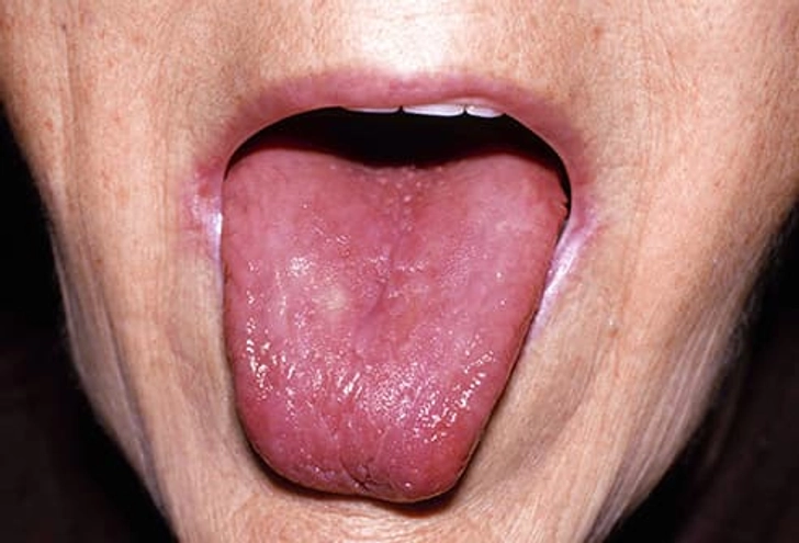 A smooth, glossy red tongue without visible papillae
