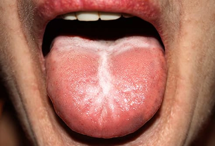 Close-up of a tongue with white, creamy fungal patches