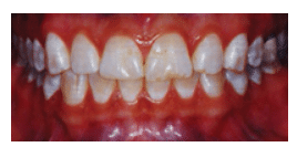 Preoperative clinical view of prominent white spots on teeth before aesthetic treatment.