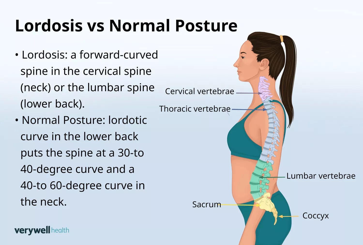 Comparison illustration showing a healthy spine with normal curves next to a spine exhibiting hyperlordosis with an exaggerated lower back arch.