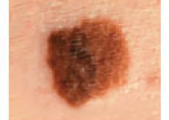 A large, dark skin spot that is wider than the diameter of a standard pencil eraser.