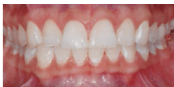 Post-treatment clinical view showing the successful removal or blending of white spots.
