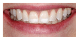 Close-up of unesthetic white spot lesions on the upper central incisors.