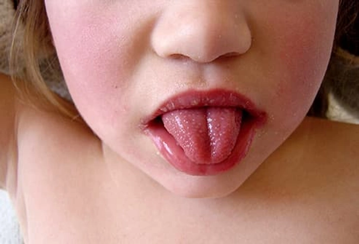 A bright red tongue with a bumpy strawberry-like appearance