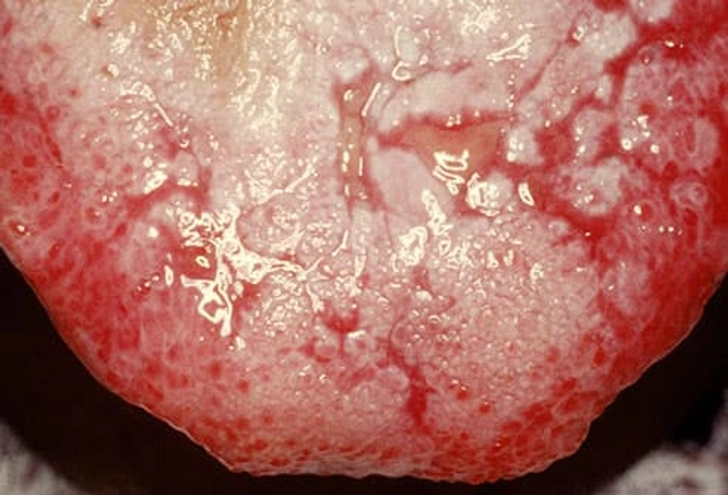 Close-up of a sore tongue with white lacy patterns of lichen planus