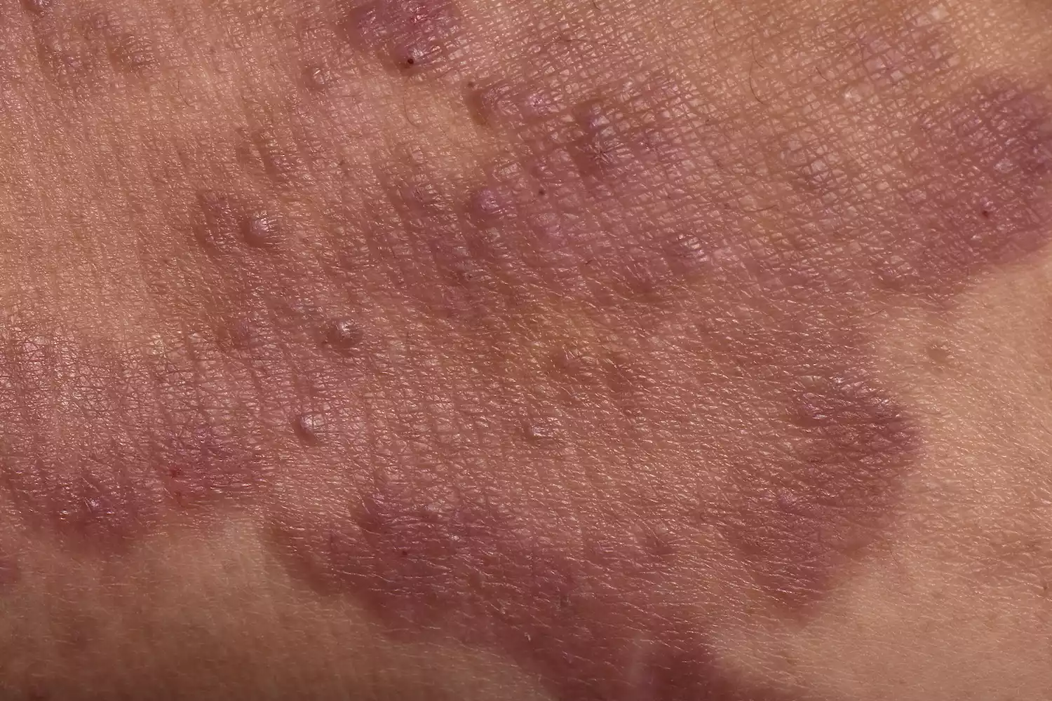 A clinical close-up showing textured skin plaques and a persistent rash on a patient's back.