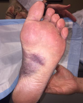 A clinical photograph showing distinct bruising on the arch of the sole of a human foot.