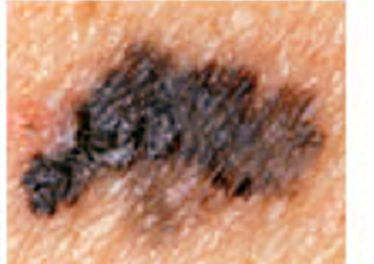 A dark mole with uneven, jagged, and poorly defined edges against light skin.