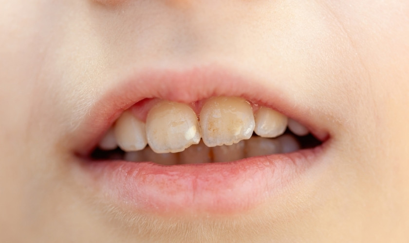 Dental White Spots: Fluoride, Minerals & Prevention