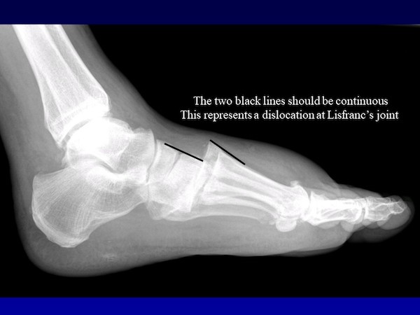 An X-ray image of a foot showing a gap between the first and second metatarsal bones, indicating a Lisfranc injury.