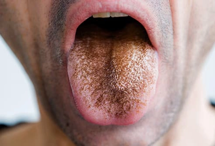 Close-up of a tongue with elongated, hair-like papillae