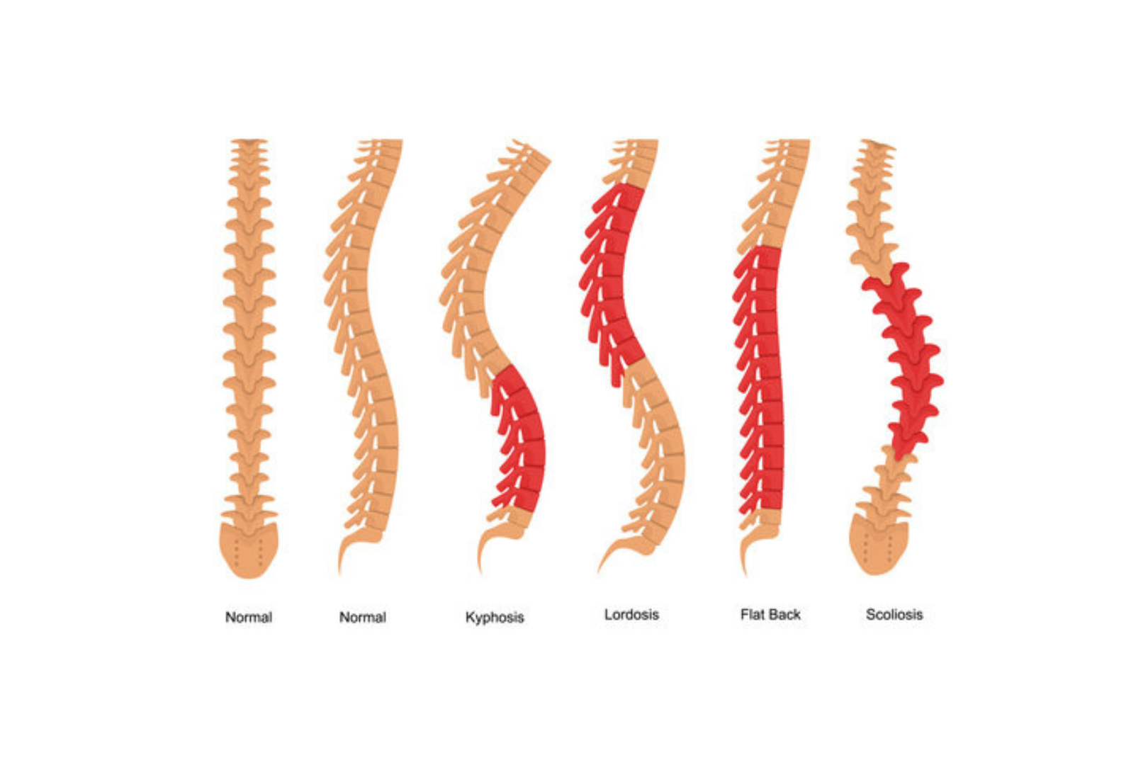 Diagram comparing three different spinal conditions: hyperlordosis of the lower back, kyphosis of the upper back, and scoliosis showing lateral curvature.
