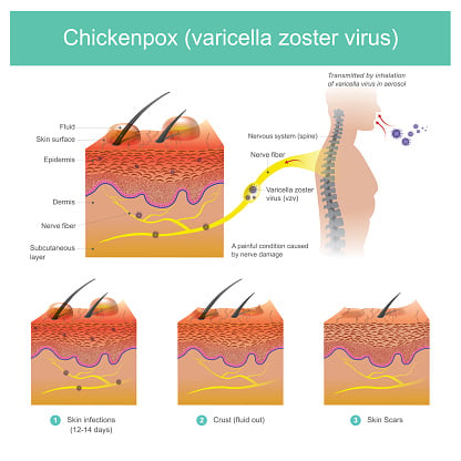 Medical illustration showing the characteristic itchy blisters of chickenpox.