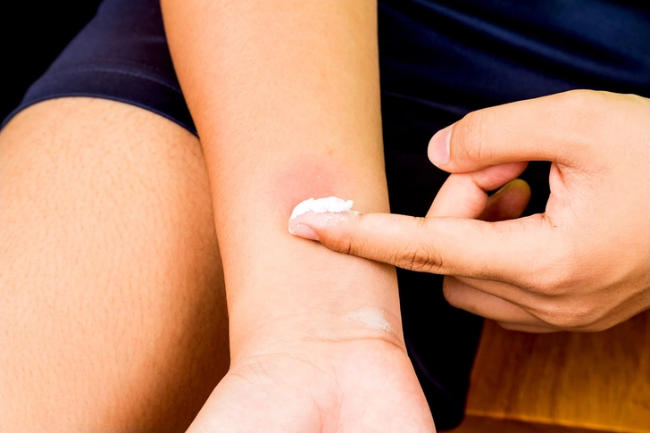 A woman applying a thick white baking soda paste to a red bug bite on her arm.
