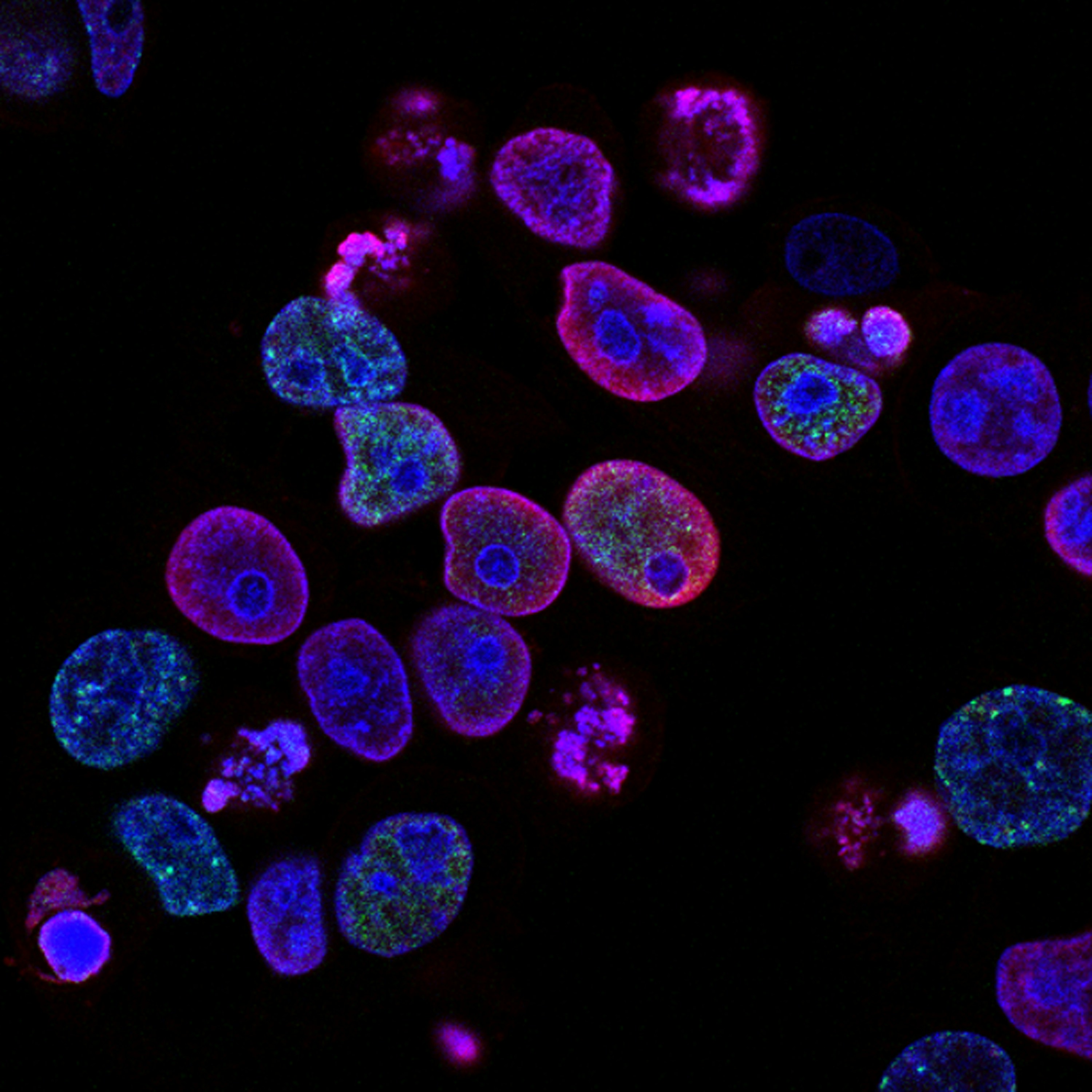Microscopic view showing the cellular structure of thyroid carcinoma.