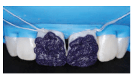 Clinical close-up of a dentist performing a localized treatment on an enamel defect.
