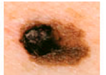 A close-up of a skin lesion where the two halves are visibly different in shape and size.